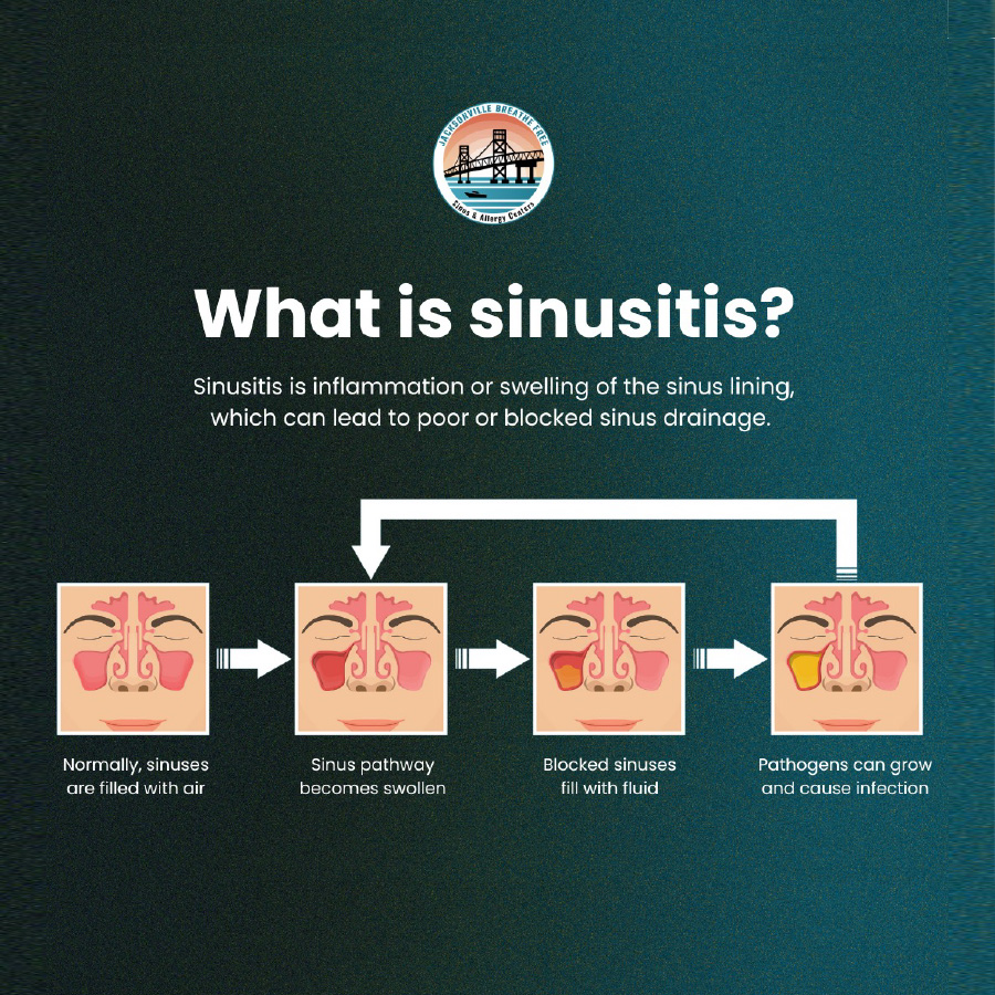 what is sinusitis
